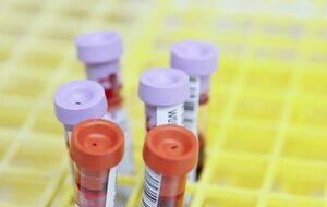 WHAT IS EARLY HIV INFECTION?